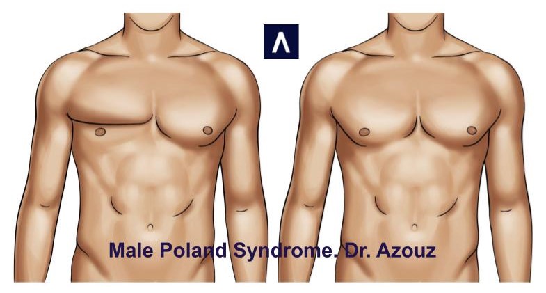 picture of Poland Syndrome before and after