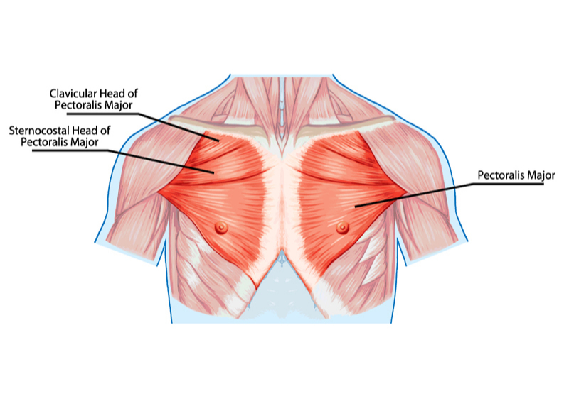 poland syndrome, graphic human body. The picture containes a 3 description of chest muscels: Clavicular Head of Pectorails Major, Sternocostal Head of Pectoralis Major and Pectoralis Major