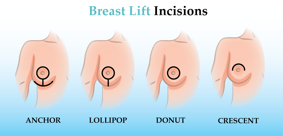 picture of breast lift incisions - anchor, lollipop, donut and crescent