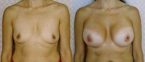 Before and After - Plastic surgery
