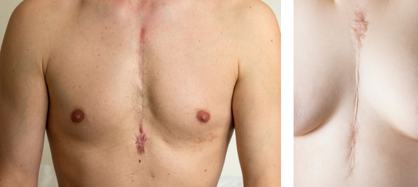 scars on man and woman chest