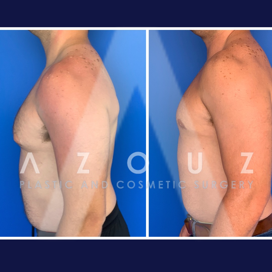 before and after gyno surgery by Dr. Solomon Azouz in Dallas, TX