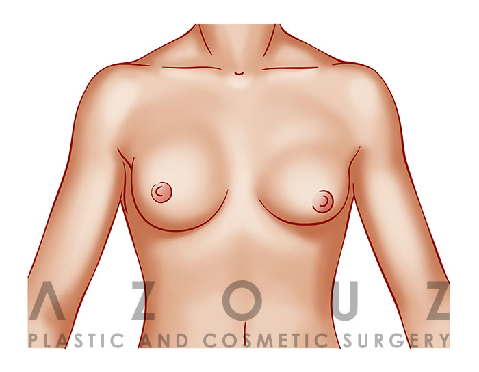 Breast implant illness: Breast explant in Dallas by Dr. Azouz
