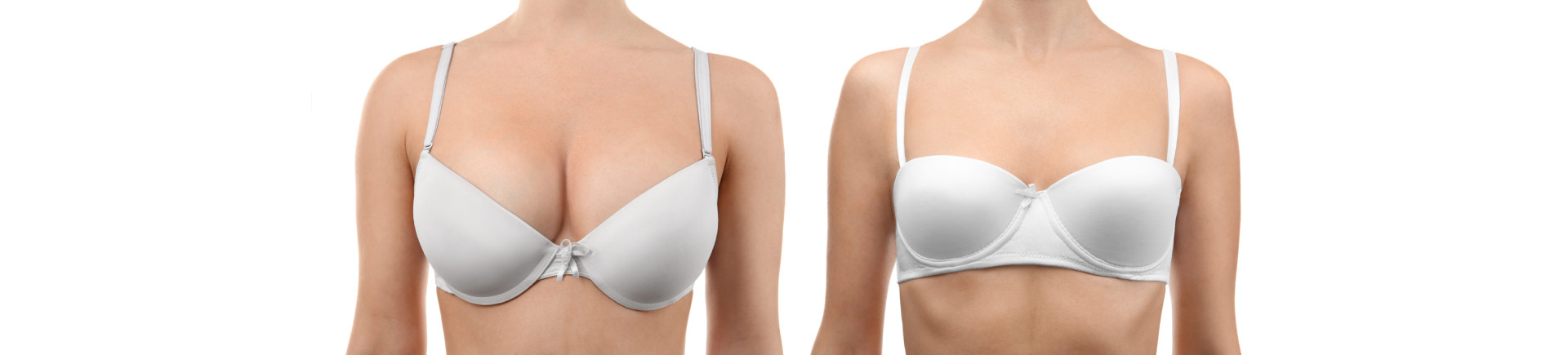 Woman's breast before and after implant removal surgery.