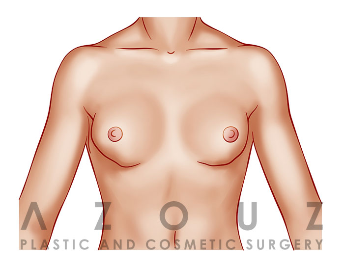 breast implant illastration