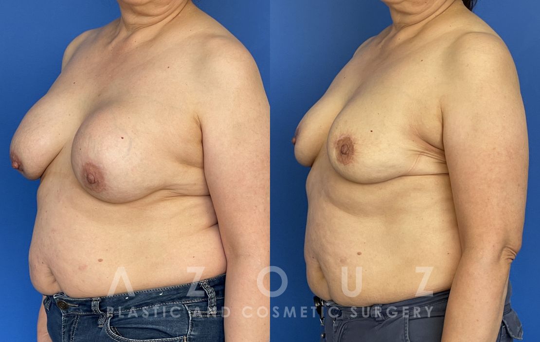 patient before and after breast implant removal