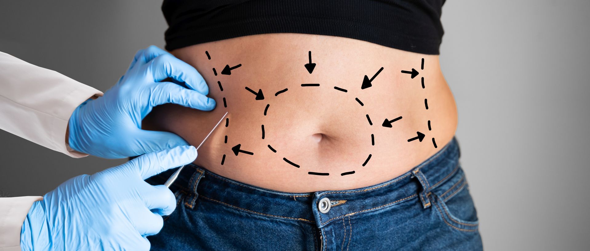 Surgical marking on a belly of a patient who is being prepared for excess fat removal and abdominal sculpting surgery.