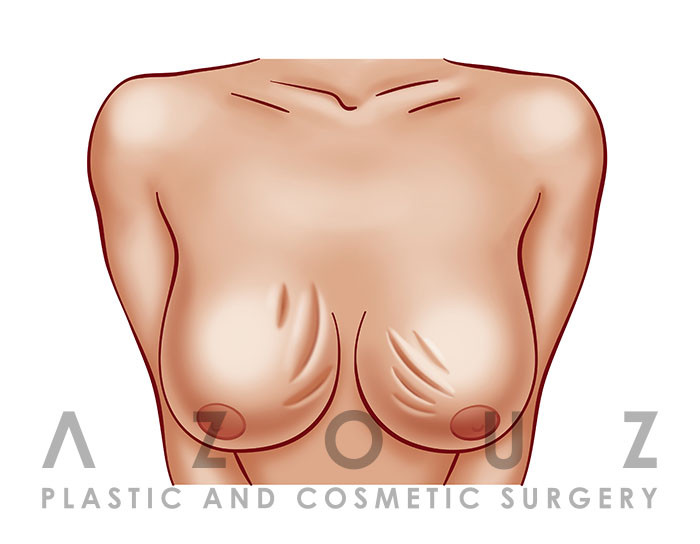 Breast implant complications: Capsular Contracture
