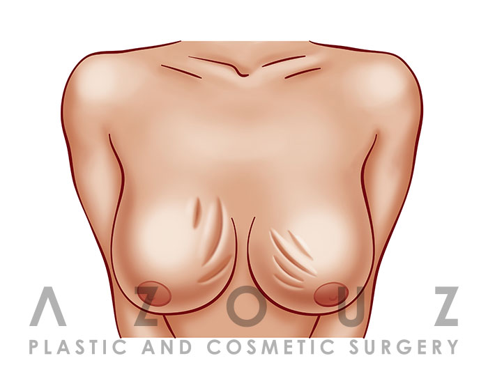 implant rippling female illastration