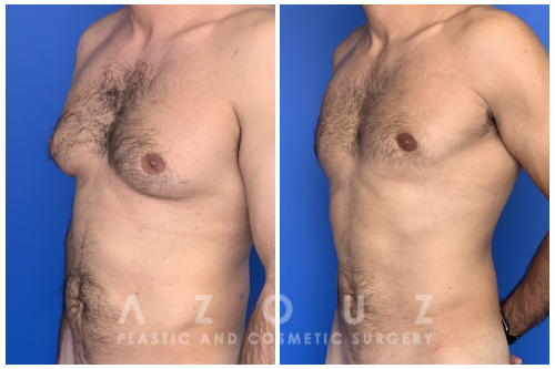 Gynecomastia Surgery before and after Dallas with Dr. Azouz