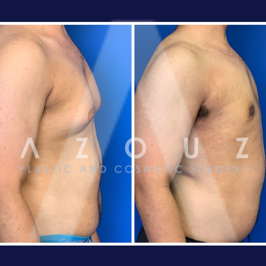 before and after male breast removal by Dr. Solomon Azouz in Dallas, TX
