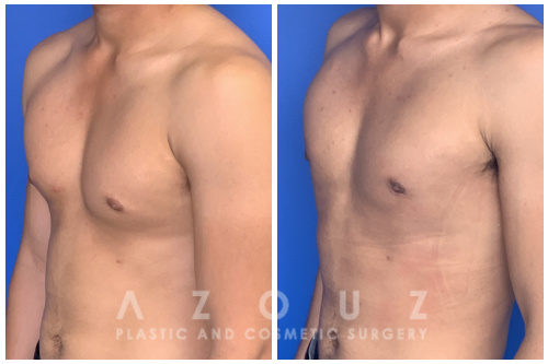 Before and After - Gynecomastia