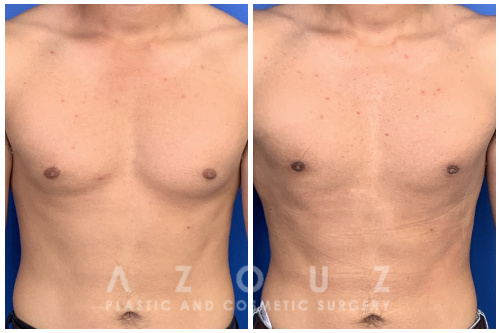 Teen Gynecomastia patient before and after gyno surgery performed by Dr. Solomon Azouz in Dallas, TX.
