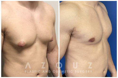 Male patient before and after gynecomastia surgery performed by Dr. Solomon Azouz in Dallas, TX.