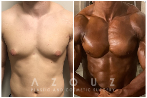 Body builder patient before and after treatment