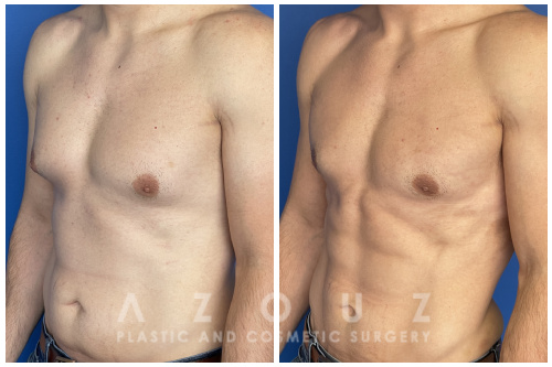 Gyno Surgery before and after Dallas with Dr. Azouz