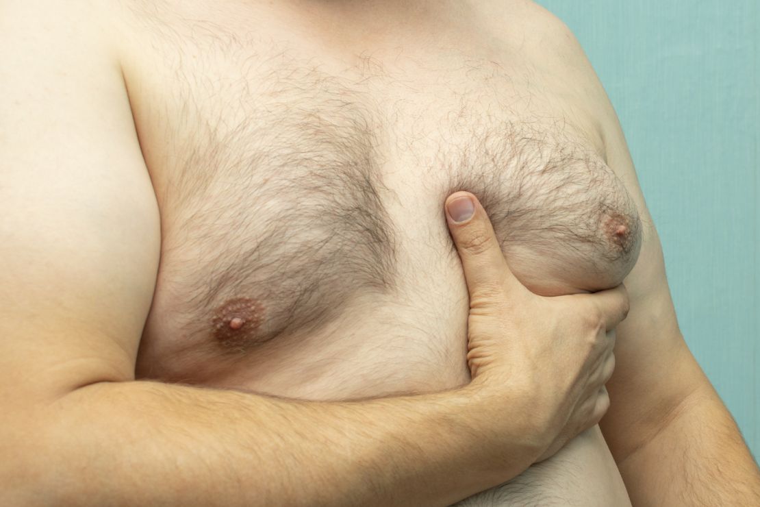 pseudoginecomastia | senos masculinos