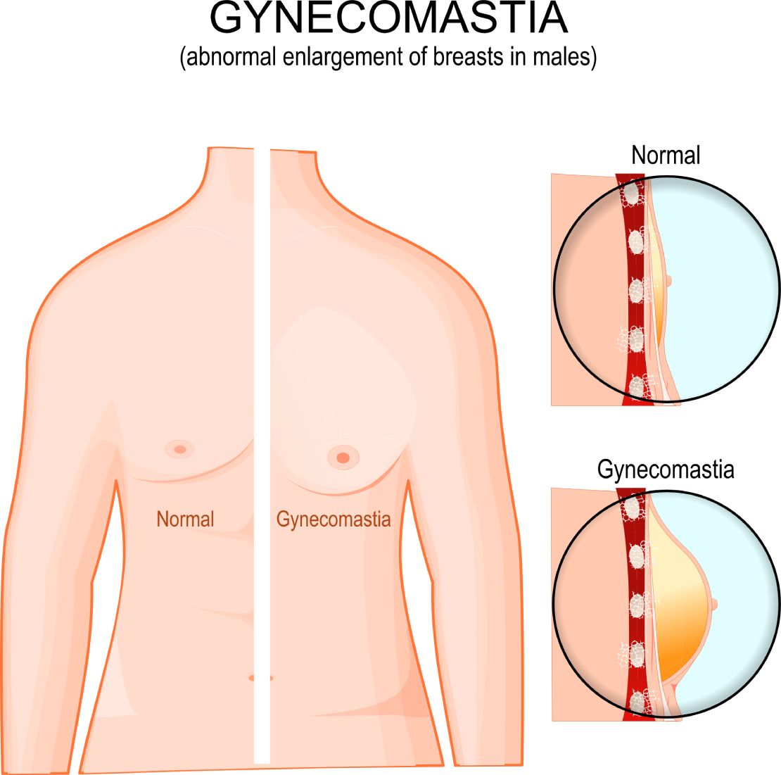 Gynecomastia - abnormal enlargement of breasts in male vs torso of healthy man