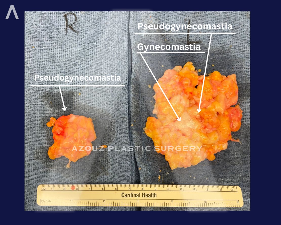 gynecomastia vs pseudogynecomastia removal surgery in Dallas, TX by Dr. Solomon Azouz
