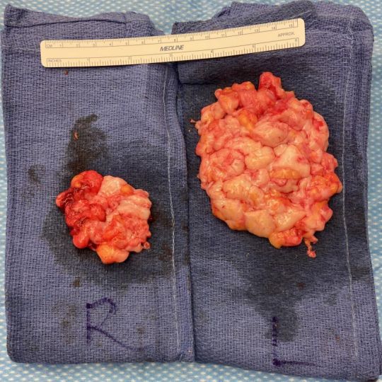 Grasa del pecho eliminada durante la cirugía de la glándula mamaria realizada por el Dr. Solomon Azouz en Dallas, TX.