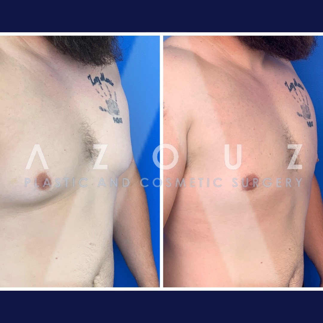 gyno removal surgery before and after by Dr. Solomon Azouz in Dallas, TX