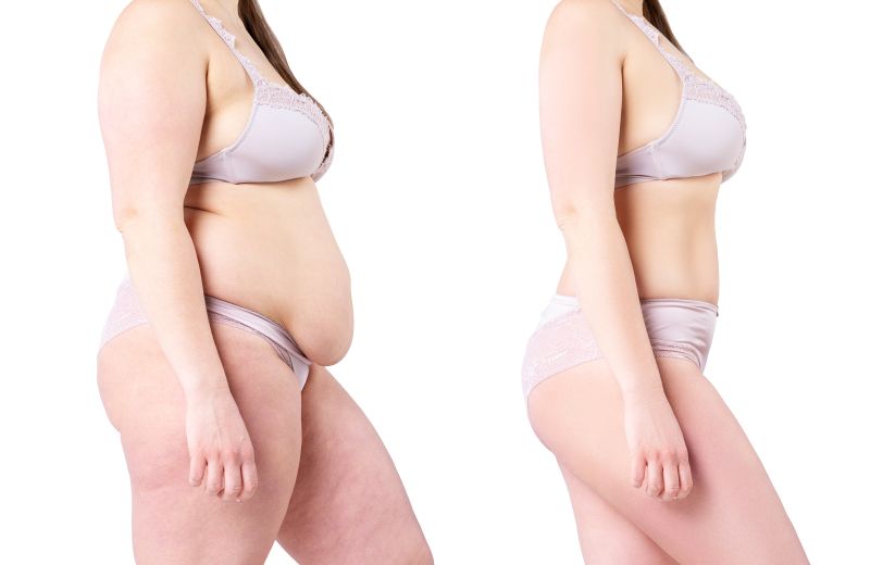 Body and skin of a woman after significant weight loss before and after skin tightening and body contouring procedures.