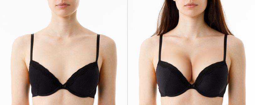 Woman's breasts before and after breast augmentation surgery.
