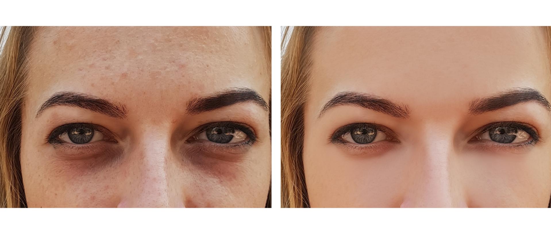 women's eyes before and after cosmetic procedures