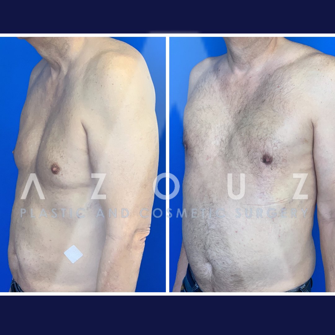 Cirugía de ginecomastia antes y después por el Dr. Solomon Azouz en Dallas, TX