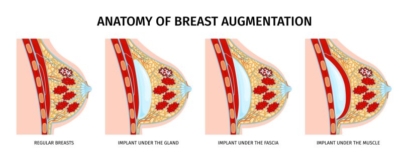 Anatomy of breast augmentation- breast implant placement in regular breasts: implant under the gland, implant under the fascia, implant under the muscle