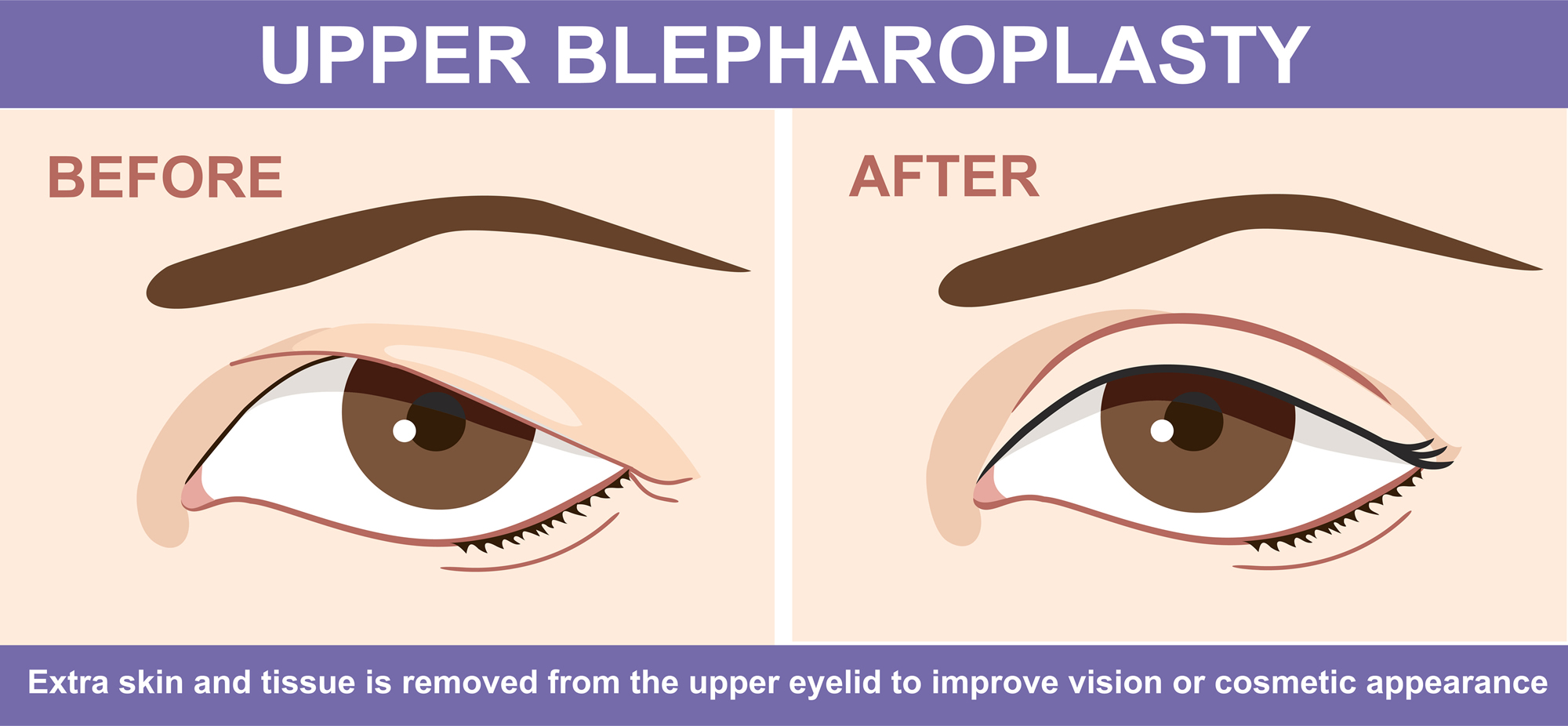 droopy eyelid | eyelid lift | upper blepharoplasty | Dallas, TX