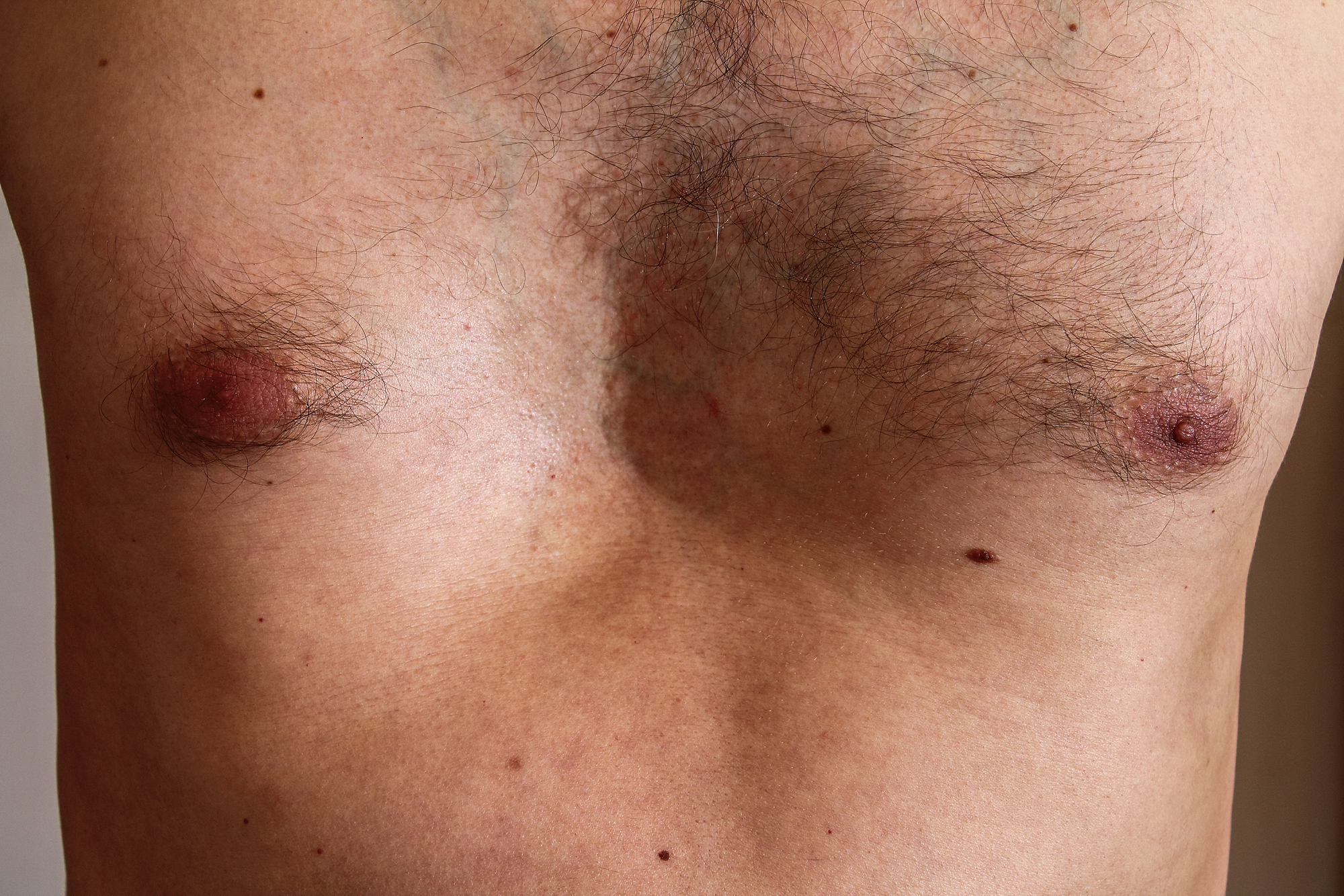 concave chest men | pectus excavatum surgery in Dallas, TX by Dr. Azouz
