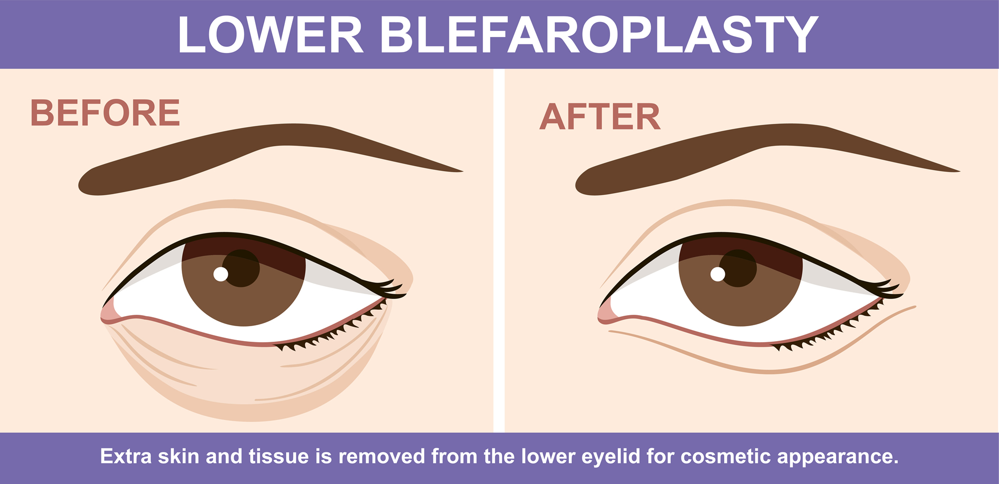 eyebag surgery | eyebag removal | lower blepharoplasty | Dallas, TX