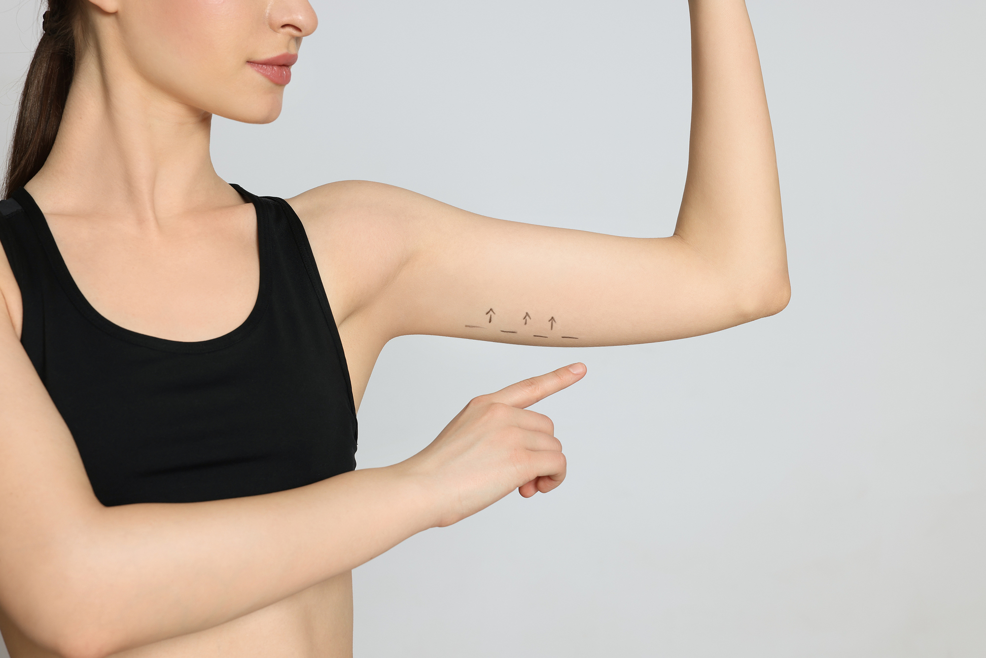 Woman with surgical marking before arm lift surgery for arm tightening.