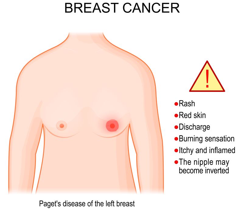 Signs of breast cancer in men: rash, red skin, discharge, burning sensation, itch and inflamed, the nipple may become inverted.