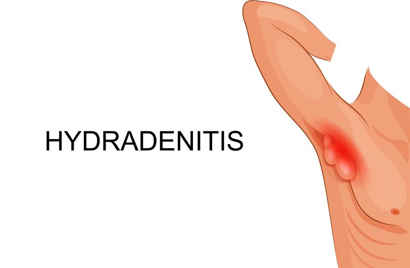 Hidradenitis Suppurativa in armpit