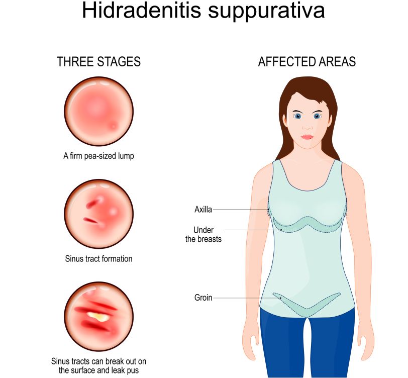 Hidradenitis suppurativa Three stages: a firm pea-sized lump, sinus tract formation, sinus tracts can break out on the surface and leak pus. Affected areas: axilla, under the breasts, groin.