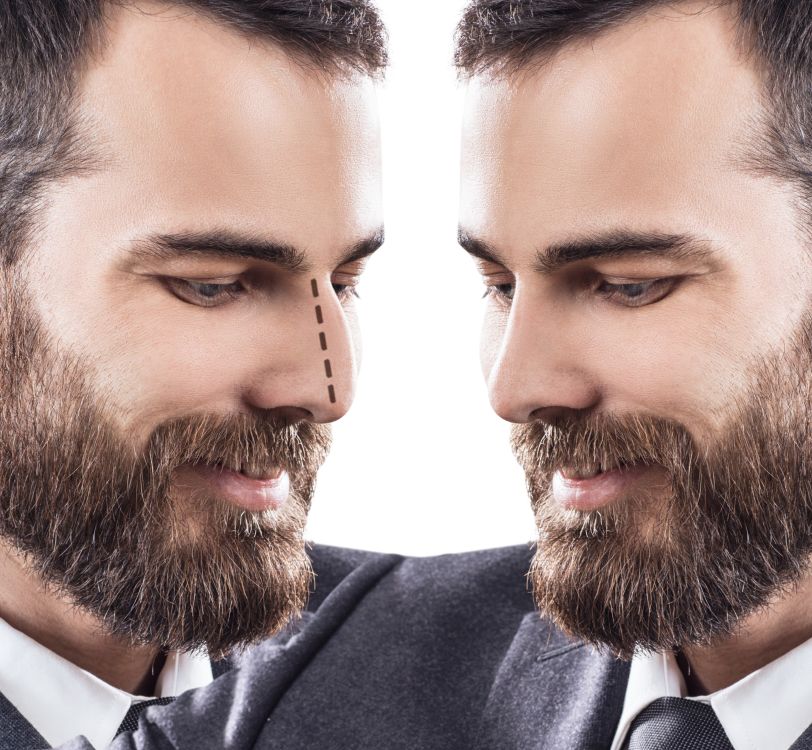 Male face before and after rhinoplasty for men.
