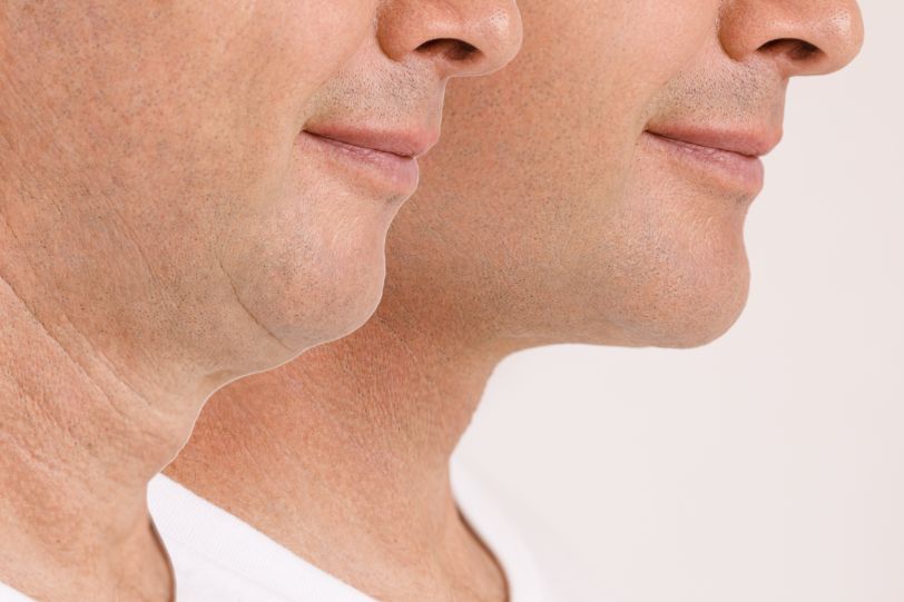 Mentón de un hombre antes y después de la cirugía de grasa debajo del mentón para reducción de doble mentón.