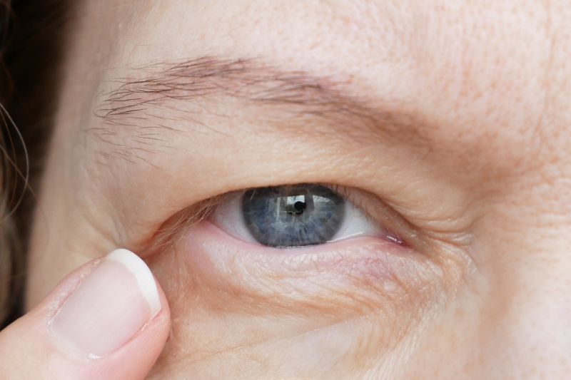Mature woman with eyelid ptosis pointing at her droopy eyelid.