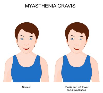 Eyelid ptosis with myasthenia gravis. Normal face compared to a face of a person with ptosis and left lower facial weakness. 