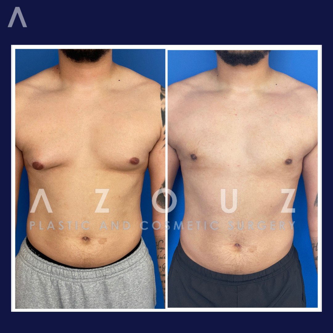 ginecomastia después de los esteroides antes y después | Dr. Solomon Azouz en Dallas, TX