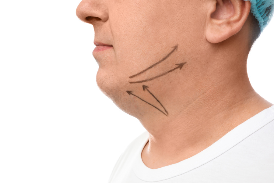 piel flácida en el cuello de los hombres | cirugía de lifting de cuello