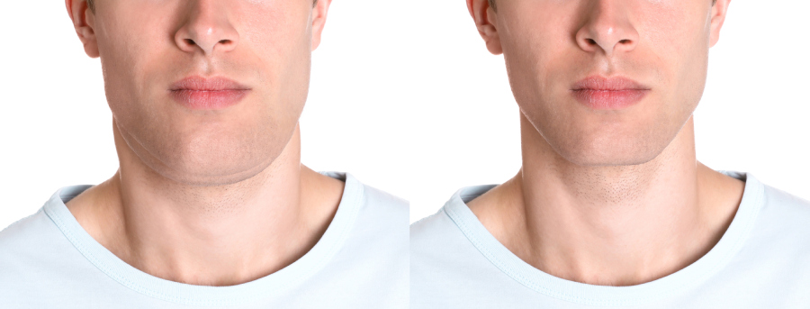 antes y después de un lifting de cuello masculino