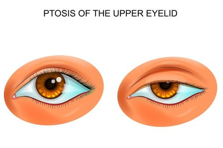 Ptosis of the upper eyelid. Eye with a droopy eyelid compared with an eye without ptosis of the eyelid.