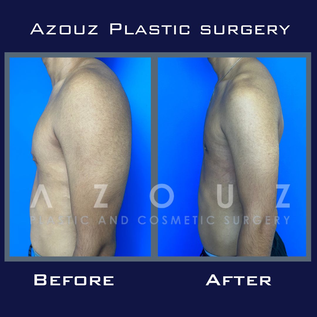 gynecomastia before and after | Dr. Solomon Azouz in Dallas, TX