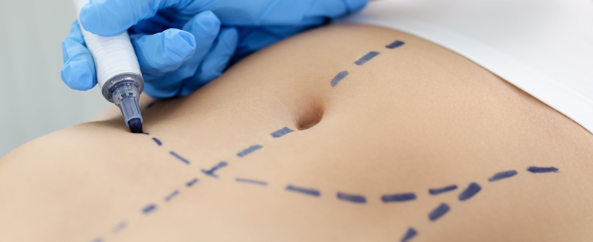 A surgeon drawing preoperative marking before abdominal wall reconstruction for a patient who suffered abdomen injury at work.
