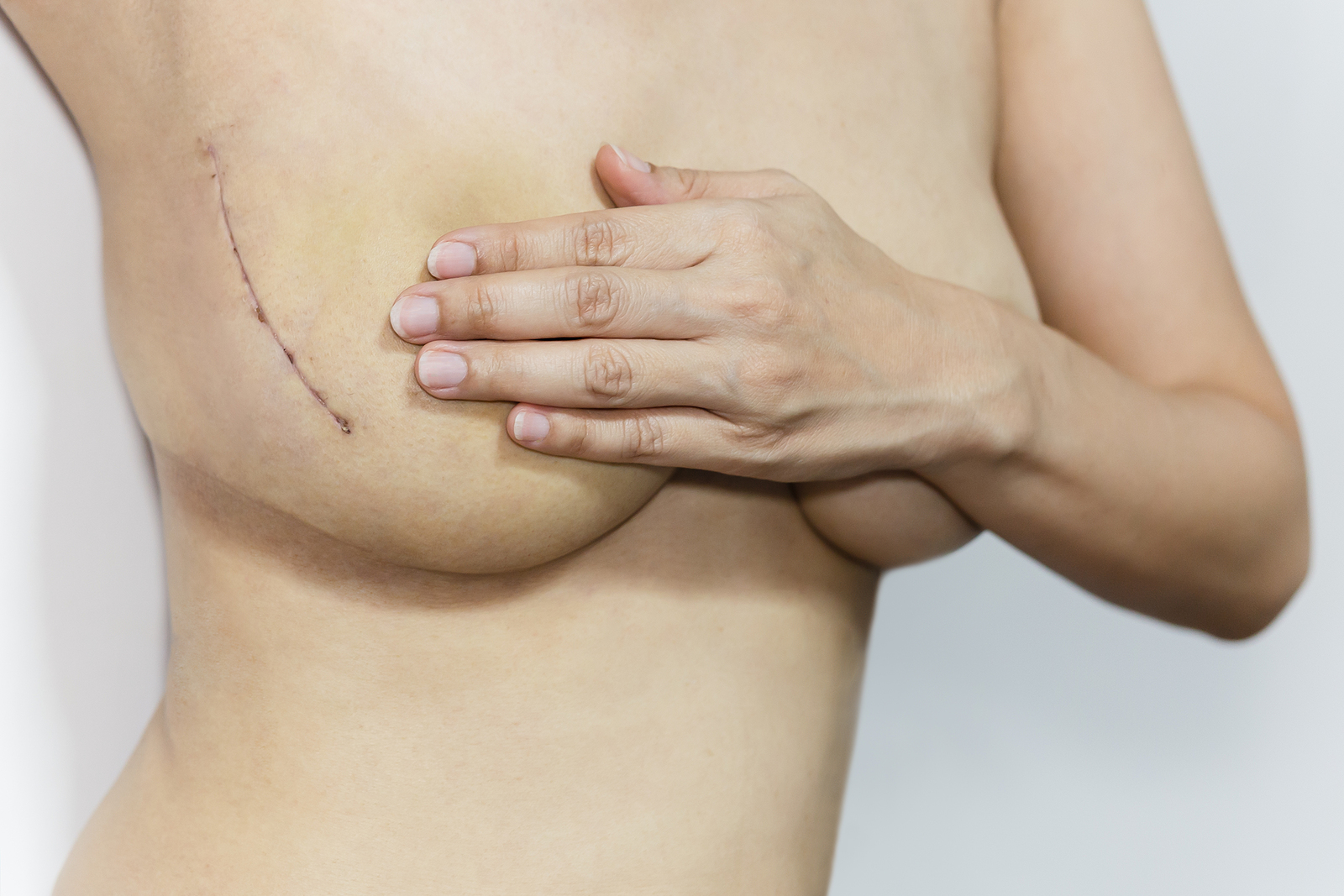 cicatrices de la extracción de implantes mamarios | cicatrices en los senos después de la cirugía