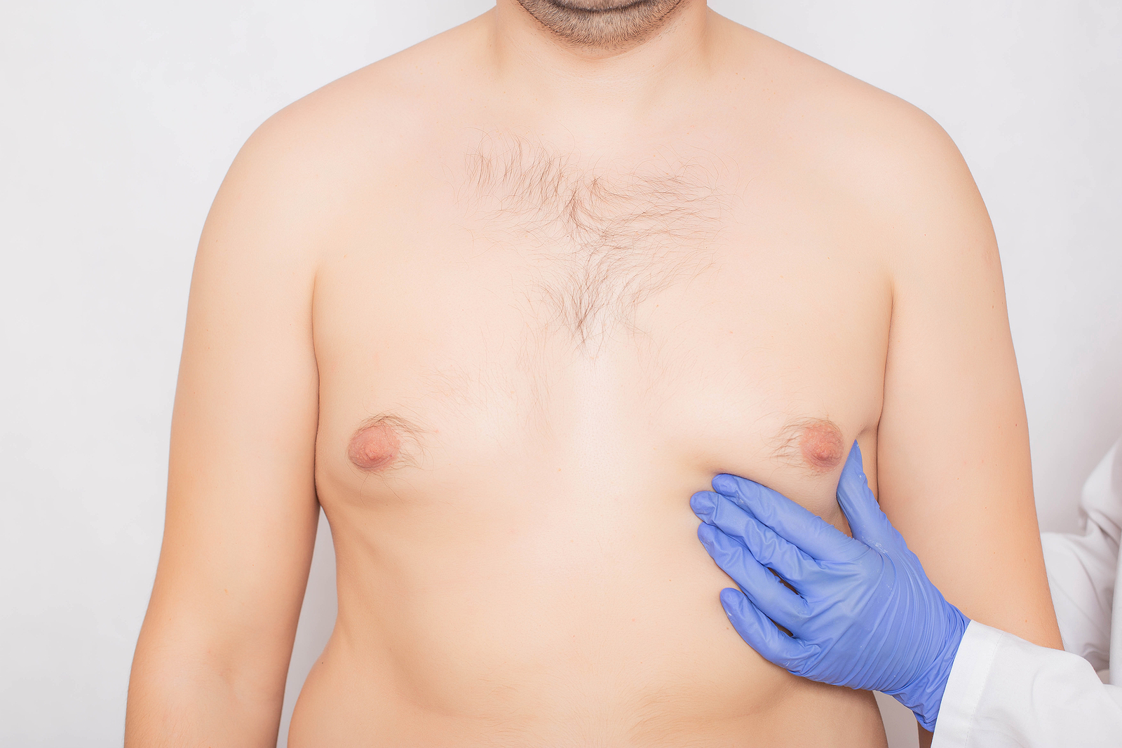 ectopic breast tissue in men | gynecomastia surgery