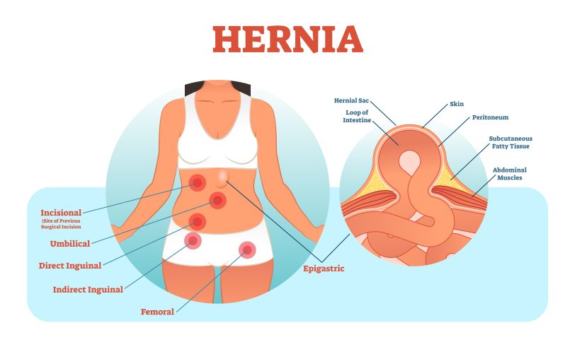 Hernia types that can be treated with hernia repair surgery.